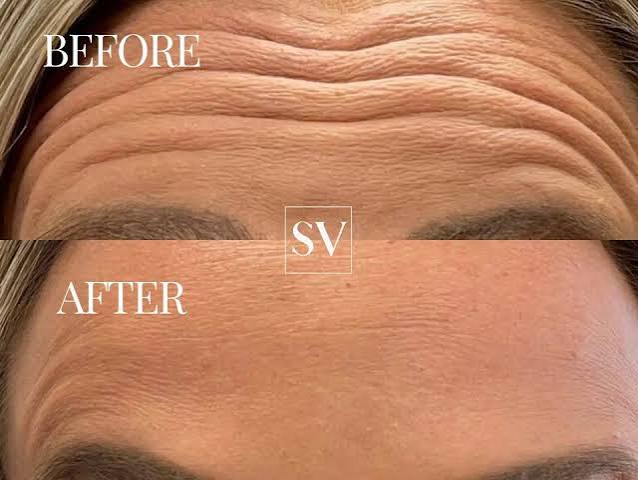 Argireline สกินแคร์ "โบท็อกซ์ในขวด" ช่วยลดริ้วรอยได้จริงแค่ไหน