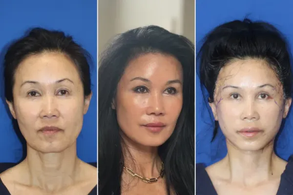 เธอไม่เคยคิดว่าจะกล้าทำเฟซลิฟต์ จนกระทั่งอายุครบ 60 ปี